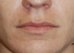 Lip Augmentation / Injection Before & After Photo