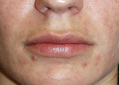 Lip Augmentation / Injection Before & After Photo