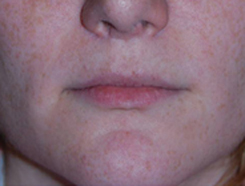 Lip Augmentation / Injection Before & After Photo