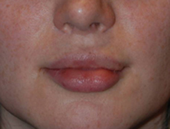 Lip Augmentation / Injection Before & After Photo