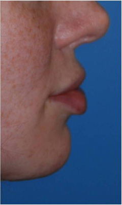 Lip Augmentation / Injection Before & After Photo