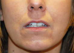 Lip Augmentation / Injection Before & After Photo