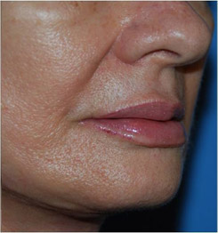 Lip Augmentation / Injection Before & After Photo