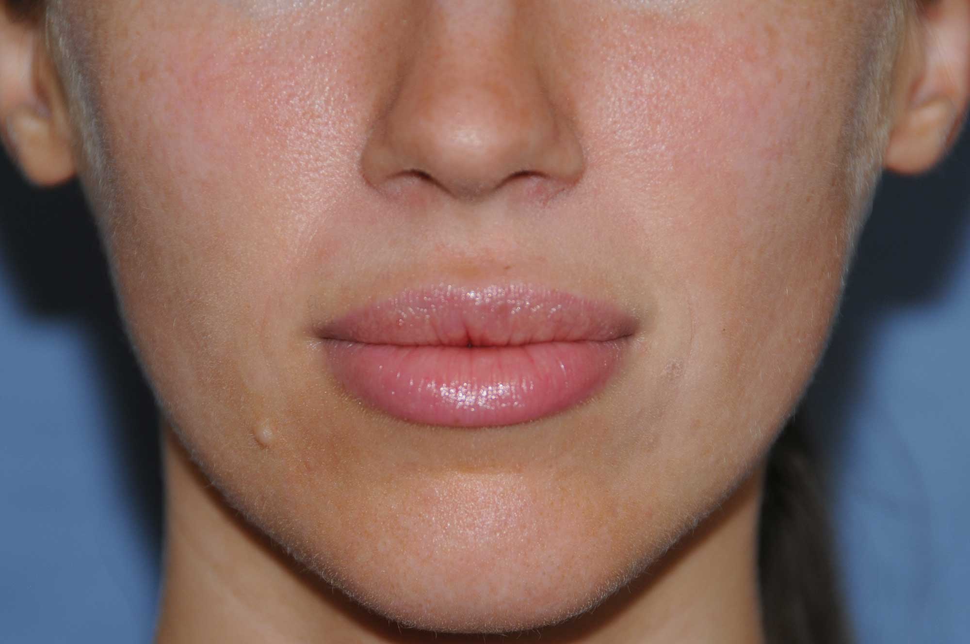 Lip Augmentation / Injection Before & After Photo