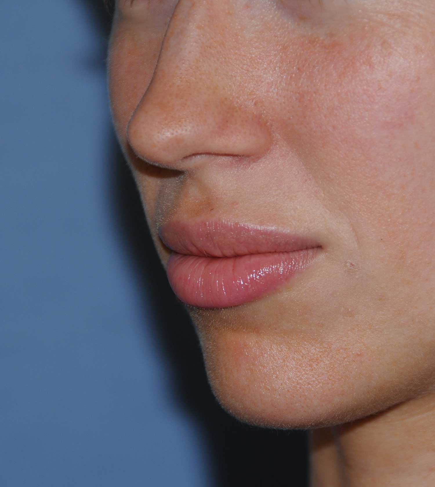 Lip Augmentation / Injection Before & After Photo