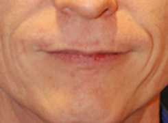 Lip Augmentation / Injection Before & After Photo