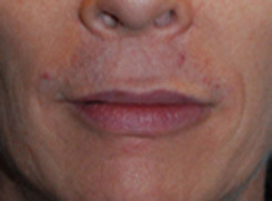 Lip Augmentation / Injection Before & After Photo