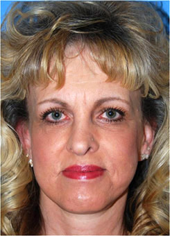 Mid Facelift Before & After Photo