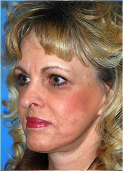 Mid Facelift Before & After Photo