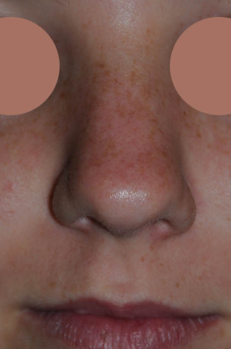 Rhinoplasty Before & After Photo