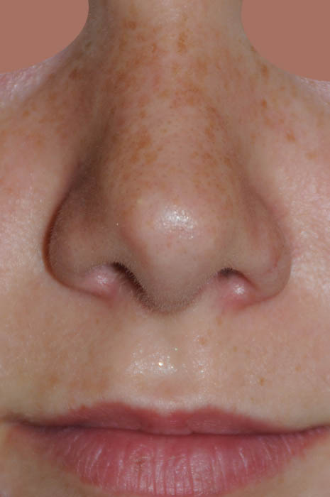 Rhinoplasty Before & After Photo