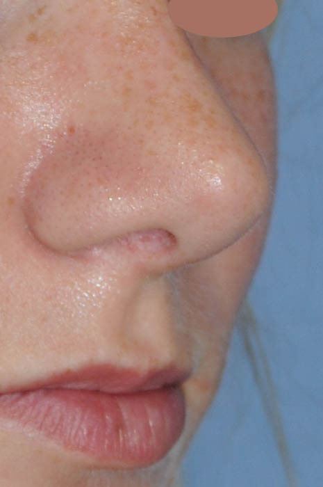 Rhinoplasty Before & After Photo