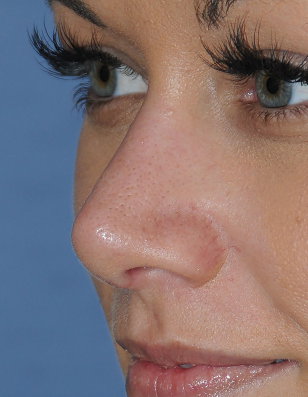 Rhinoplasty Before & After Photo