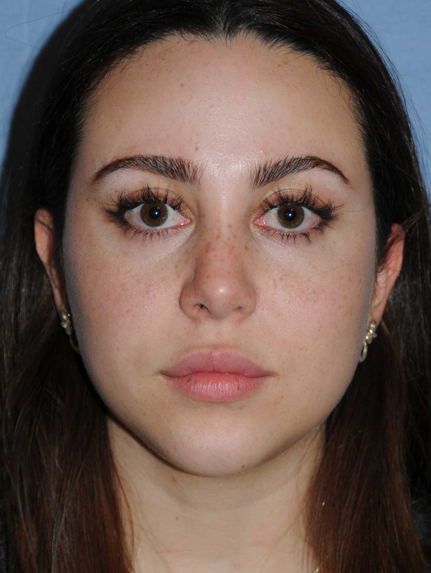 Rhinoplasty Before & After Photo