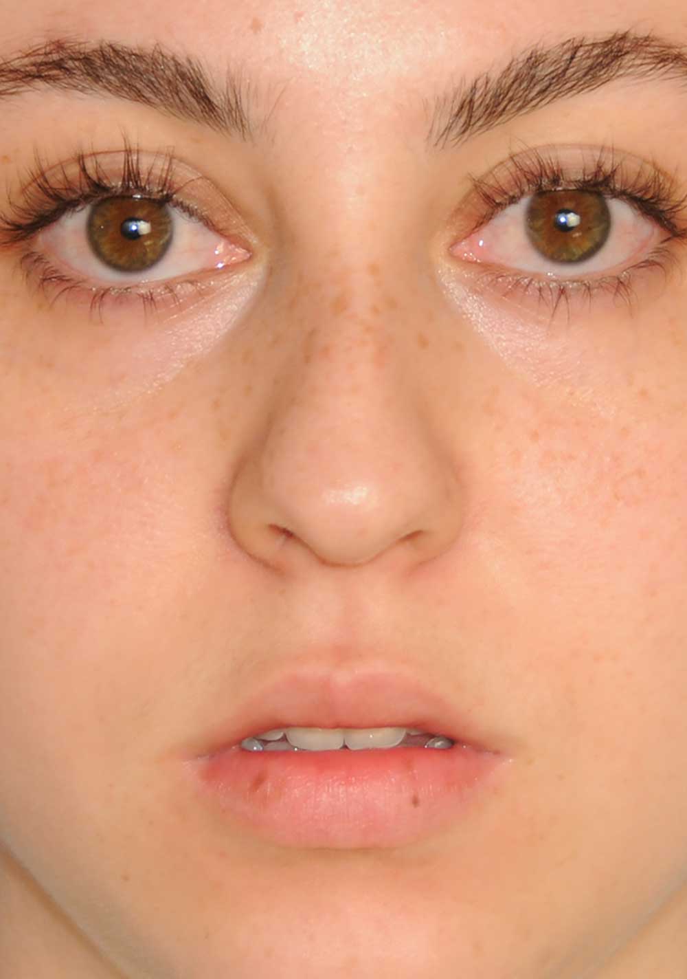 Rhinoplasty Before & After Photo