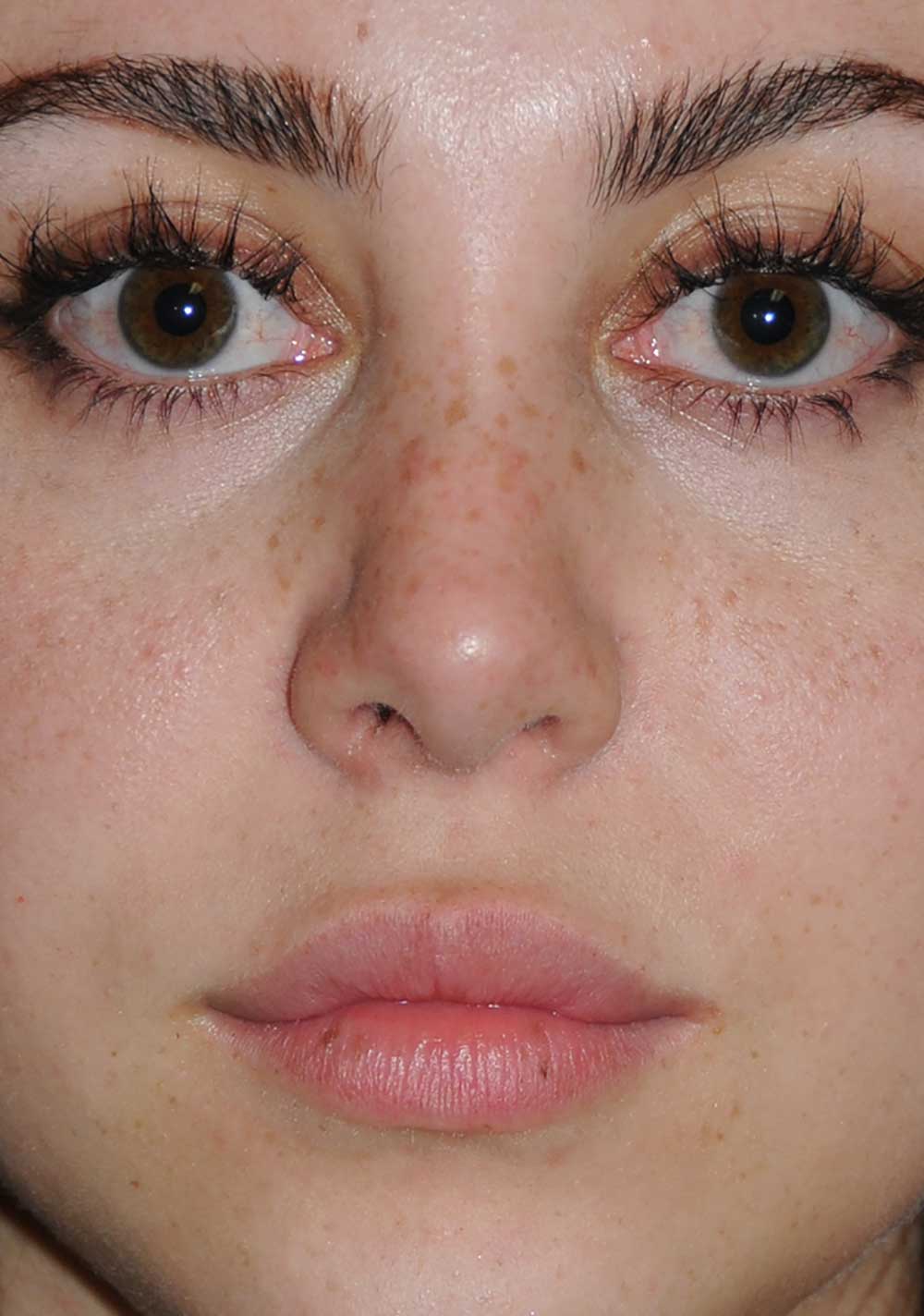 Rhinoplasty Before & After Photo