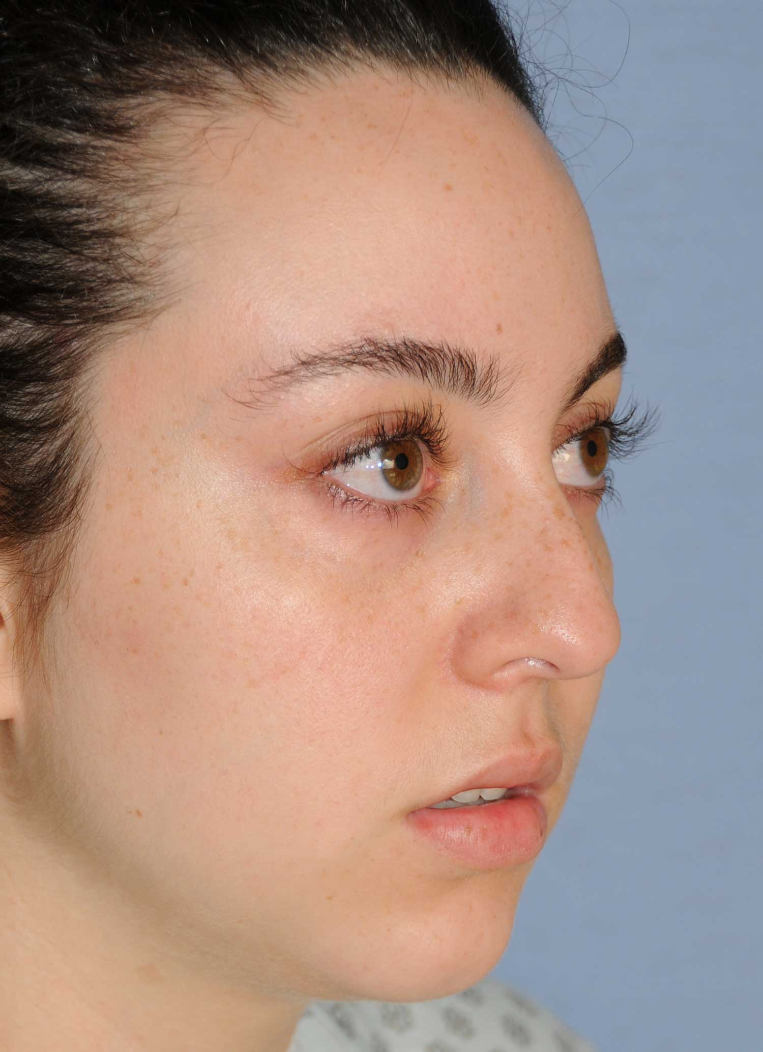 Rhinoplasty Before & After Photo