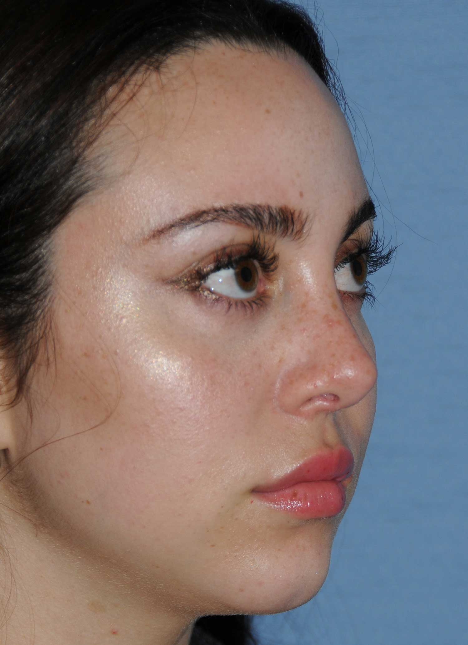 Rhinoplasty Before & After Photo