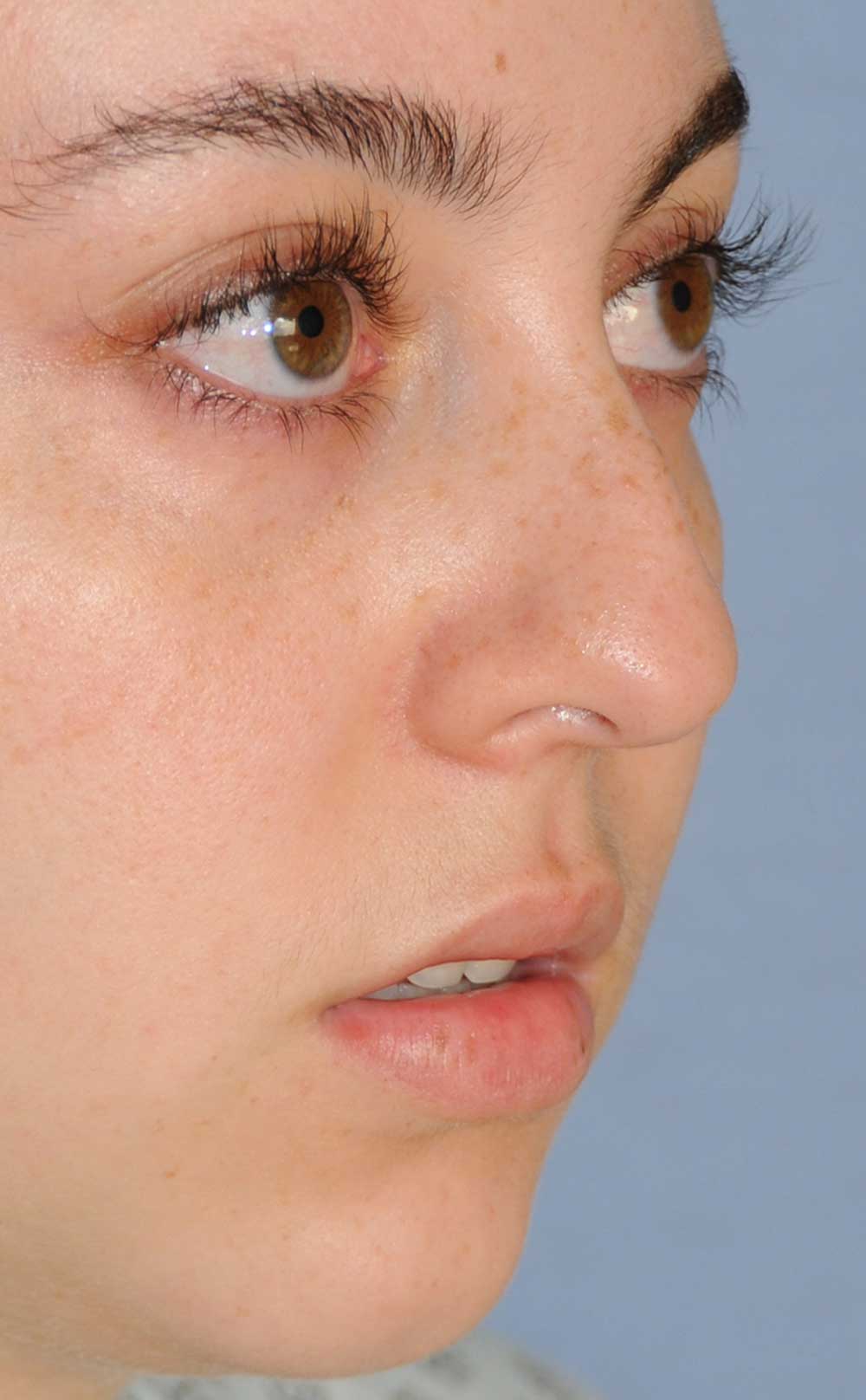 Rhinoplasty Before & After Photo