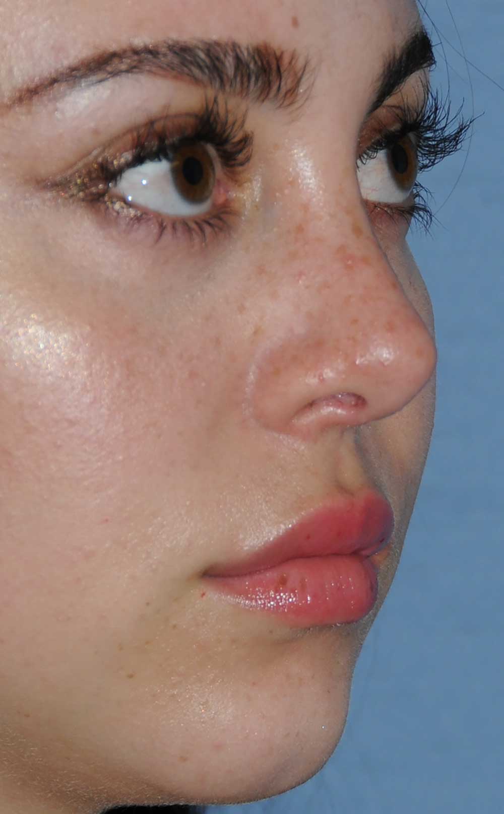 Rhinoplasty Before & After Photo