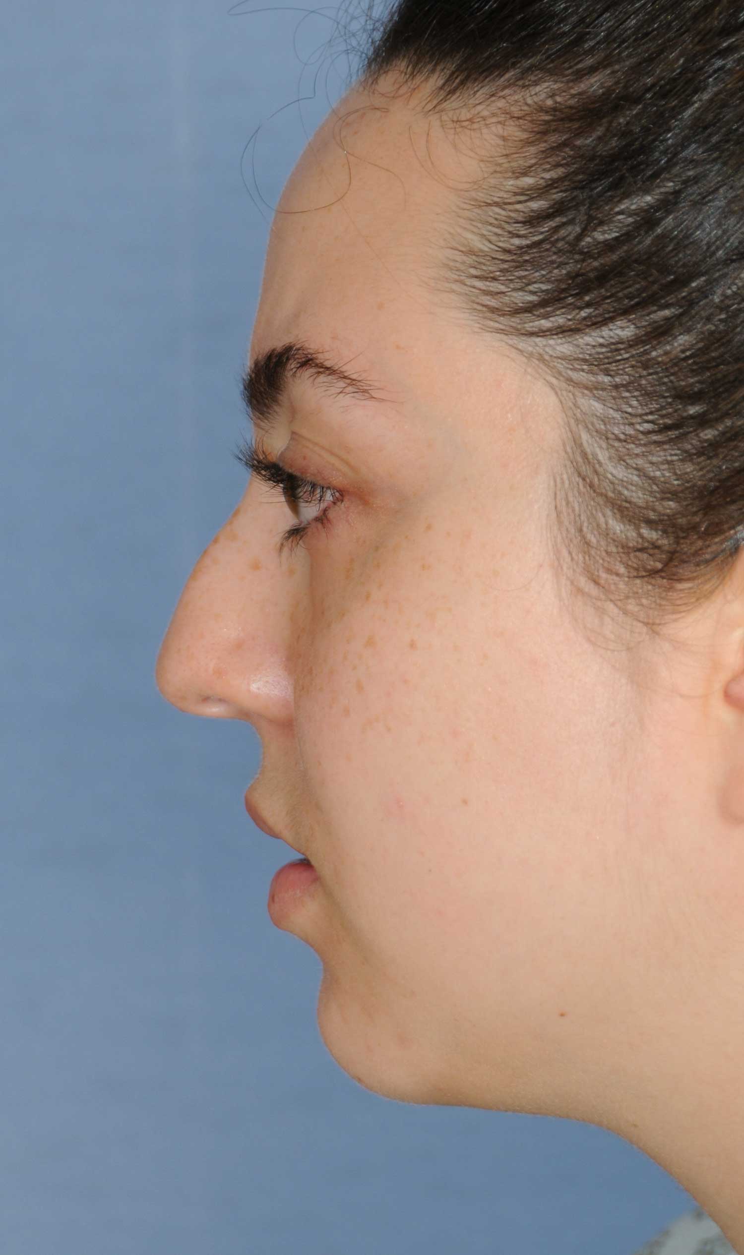 Rhinoplasty Before & After Photo