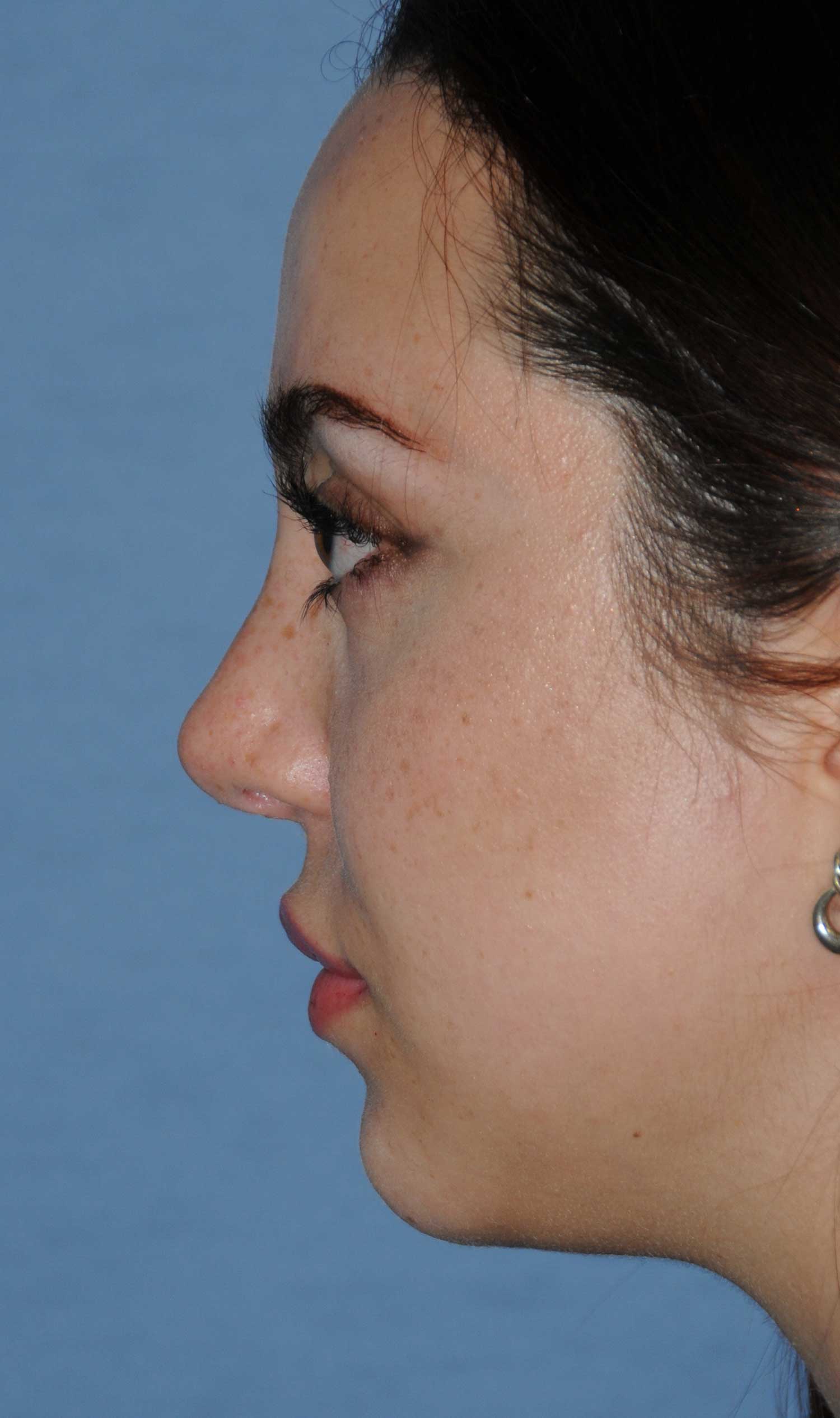 Rhinoplasty Before & After Photo