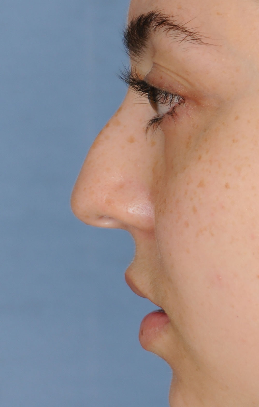 Rhinoplasty Before & After Photo