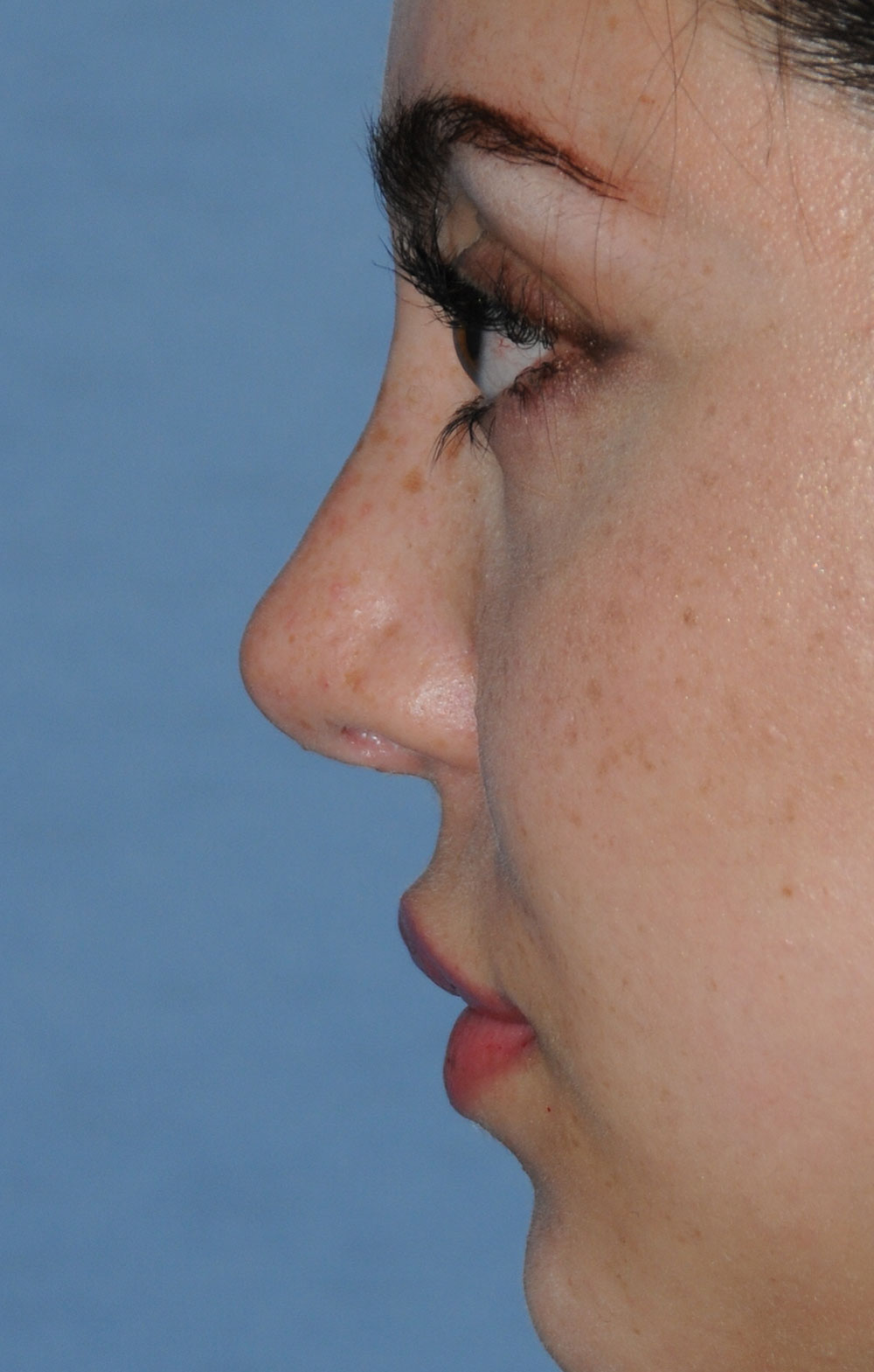 Rhinoplasty Before & After Photo