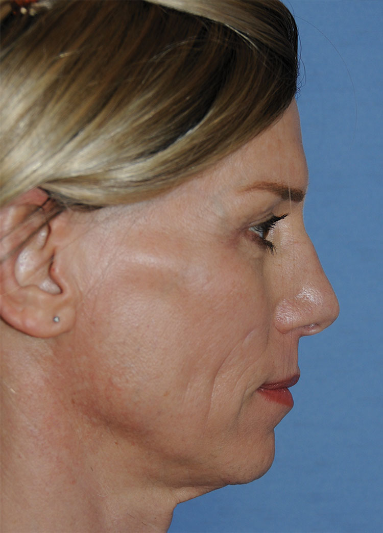 Rhinoplasty Before & After Photo