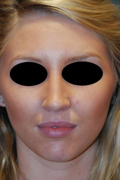 Rhinoplasty Before & After Photo