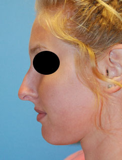 Rhinoplasty Before & After Photo