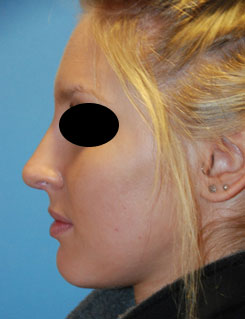 Rhinoplasty Before & After Photo