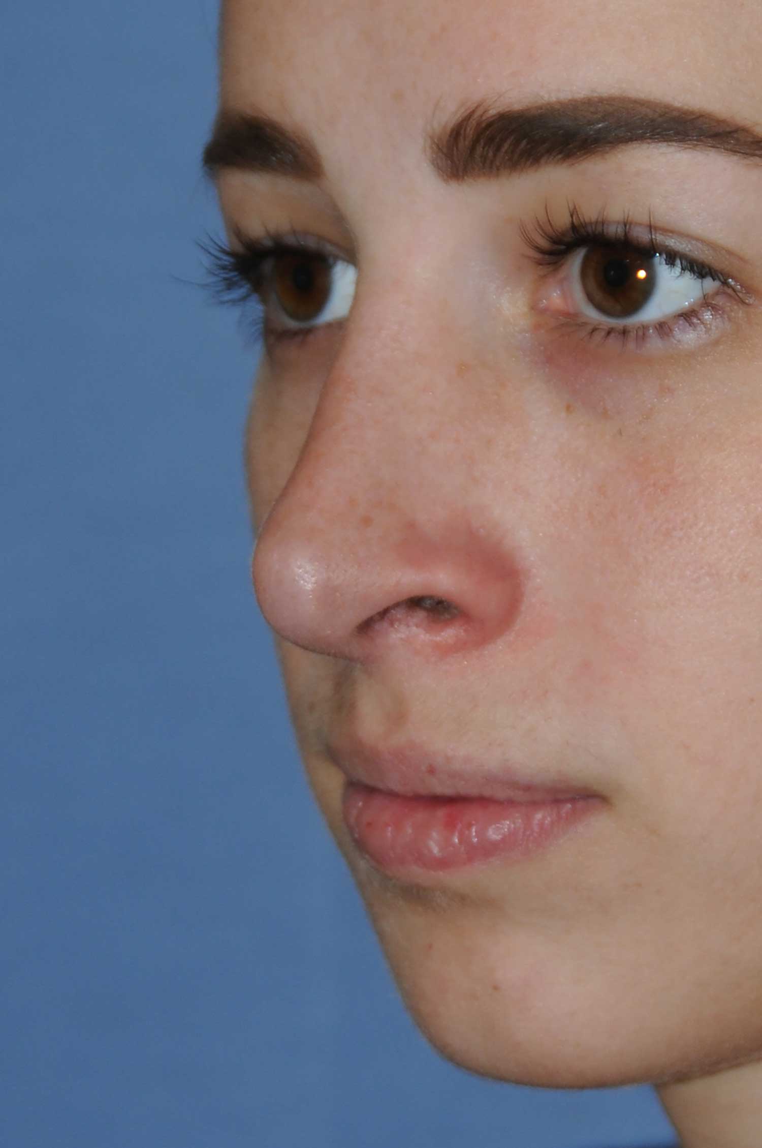 Rhinoplasty Before & After Photo