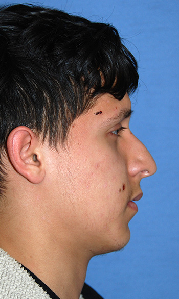 Rhinoplasty Before & After Photo