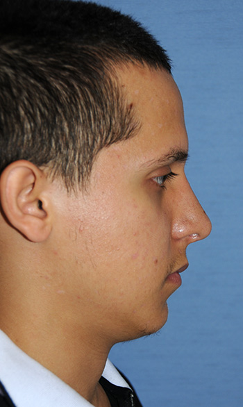 Rhinoplasty Before & After Photo