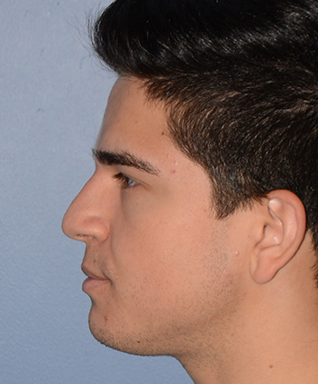 Rhinoplasty Before & After Photo