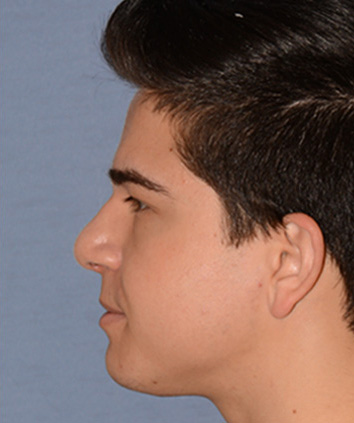 Rhinoplasty Before & After Photo