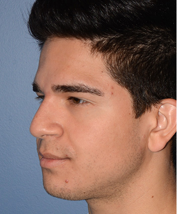 Rhinoplasty Before & After Photo