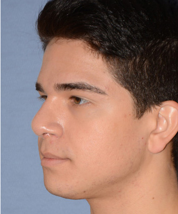 Rhinoplasty Before & After Photo