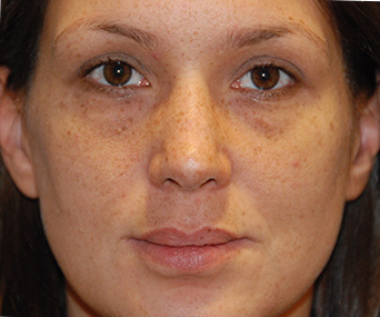 Rhinoplasty Before & After Photo