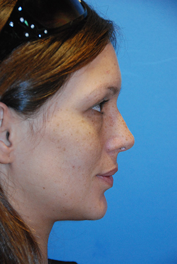 Rhinoplasty Before & After Photo