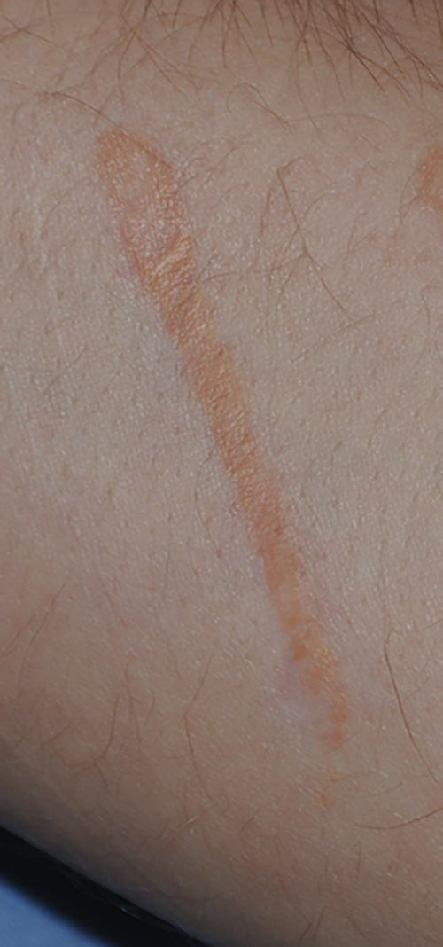Scar Revision Before & After Photo