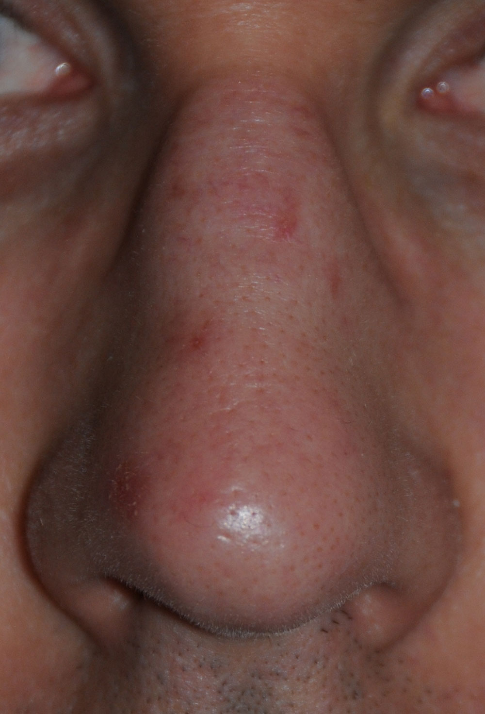 Nose laser resurfacing & scar revision before photo from Dr Philip Young in Beleveu Washington