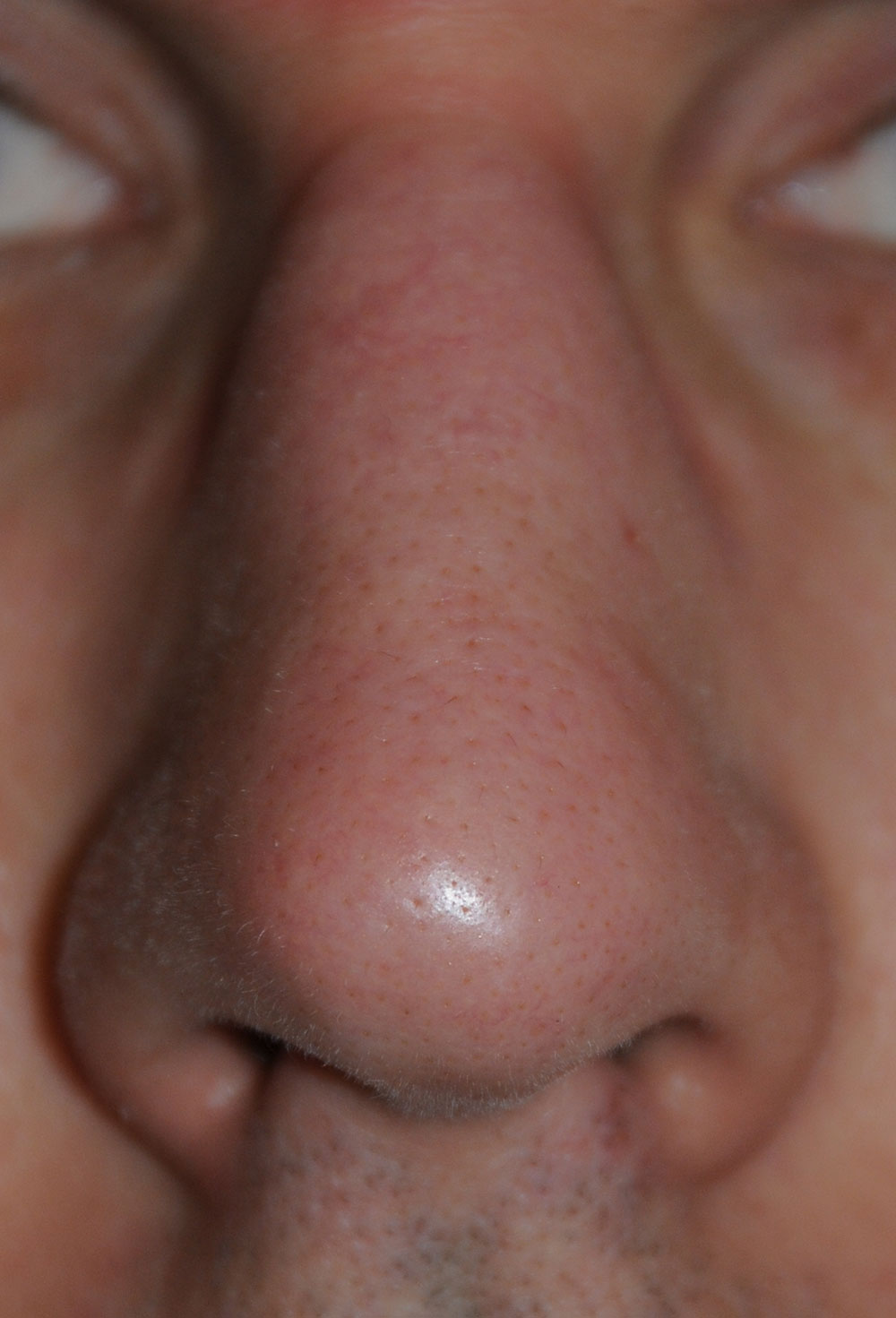 Nose laser resurfacing & scar revision before photo from Dr Philip Young in Beleveu Washington