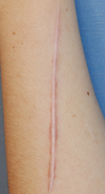 Scar Revision Before & After Photo