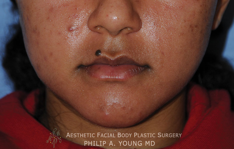 Skin Lesion Before & After Photo