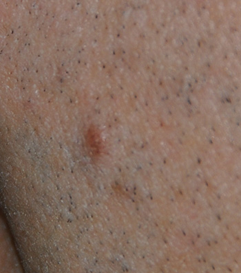 Skin Lesion Before & After Photo
