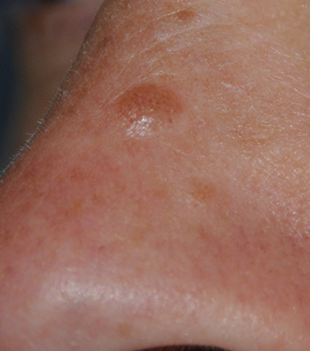 Skin Lesion Before & After Photo