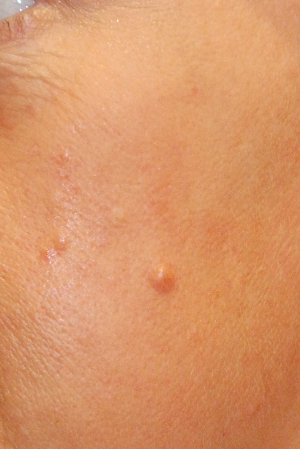 Skin Lesion Before & After Photo