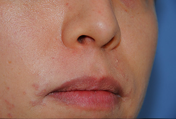 Skin Lesion Before & After Photo